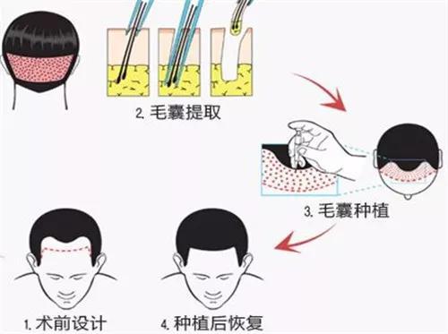 不要幻想！秃了不能变强或者根治772 / 作者:UFO外星人爱好者 / 帖子ID:32187