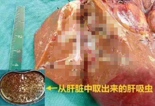 恐怖！男子因习惯吃生鱼片肝脏被上百条虫掏空194 / 作者:UFO外星人爱好者 / 帖子ID:32318