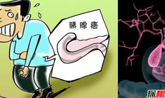 最难治愈的十大癌症,胰腺癌被称为癌中之王753 / 作者:伤我心太深 / 帖子ID:47955
