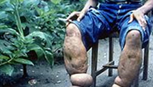 惊人!象皮病是什么病,象皮病可以治愈吗708 / 作者:小深 / 帖子ID:48274