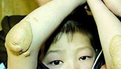 什么是库兴氏综合症?分泌过量糖皮质激素所致的疾病643 / 作者:明明是我 / 帖子ID:48643