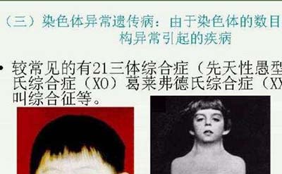 猫叫综合症的临床表现是什么?能活多久558 / 作者:ufo是假象 / 帖子ID:49418