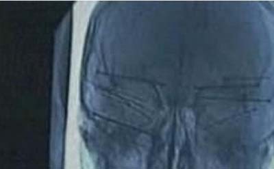 全球十位死不了的人，铁棍穿头炸飞10米远104 / 作者:网上的人生 / 帖子ID:49252