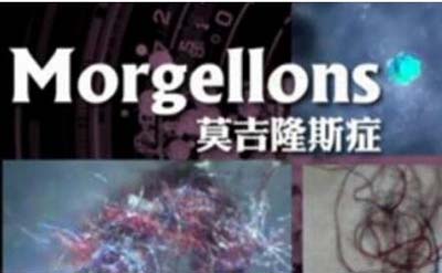 转基因莫吉隆斯症103 / 作者:网上的人生 / 帖子ID:49309