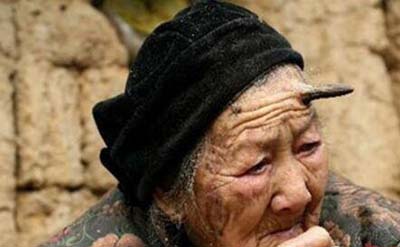 百岁老人头上长“犄角”之谜，预示癌症病变397 / 作者:网上的人生 / 帖子ID:49836