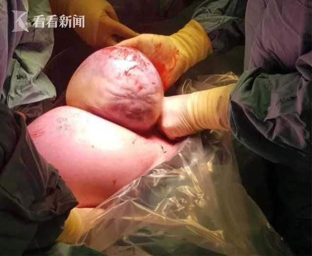羊水未破就被剖腹产? 男婴包膜出生! 活像外星人45 / 作者:donaldjackie / 帖子ID:52507