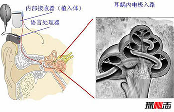 人造耳蜗多少钱 为什么这么贵267 / 作者:网上的人生 / 帖子ID:52983
