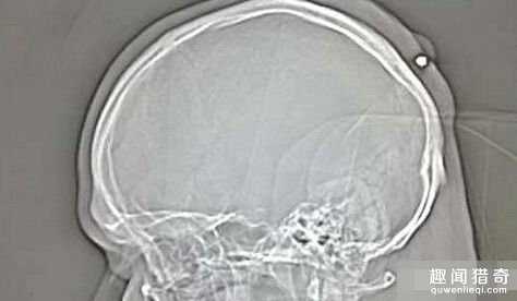 盘点全球最命大的人：连头上中了一枪都没事746 / 作者:UFO来啦 / 帖子ID:65107