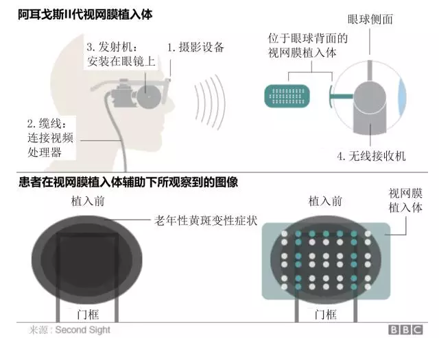 这种仿生眼植入体,能让失明的人重见光明695 / 作者:UFO爱好者 / 帖子ID:86446 这种仿生眼植入体,能让失明的人重见光明695 / 作者:UFO爱好者 / 帖子ID:86446