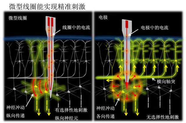 植入微型线圈，治疗抑郁症157 / 作者:UFO爱好者 / 帖子ID:86440