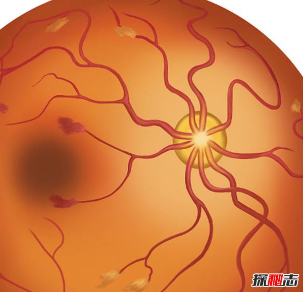 过山车致严重眼病?武汉大学生玩过山车致视网膜脱落(700度近视)935 / 作者:UFO爱好者 / 帖子ID:105451
