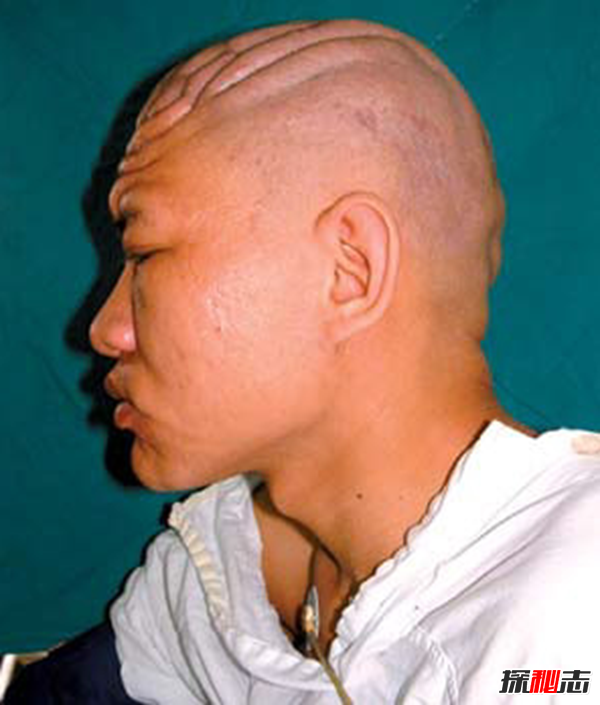 广州女孩患骨膜增生厚皮症,面部褶皱如古稀老人(染色体显性遗传)798 / 作者:UFO爱好者 / 帖子ID:105435