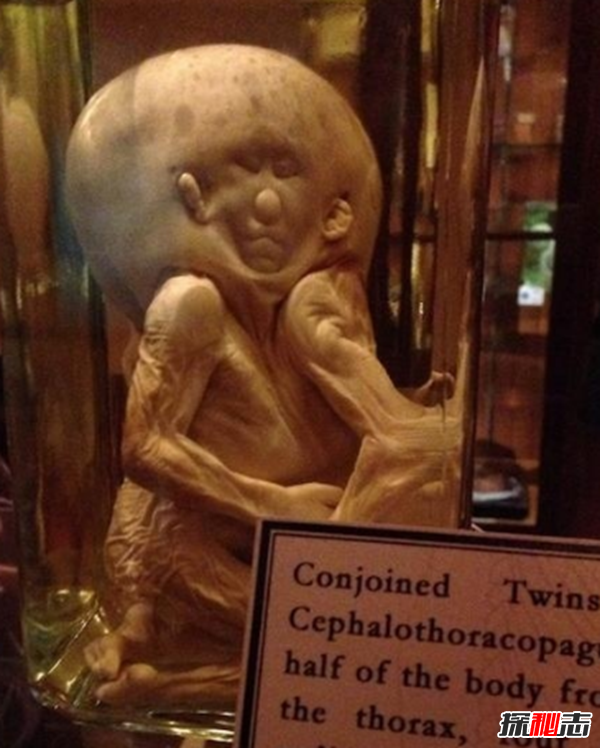 美国穆特博物馆肥皂女尸,重口味分分钟想吐(腐烂女尸成肥皂)481 / 作者:UFO爱好者 / 帖子ID:105426