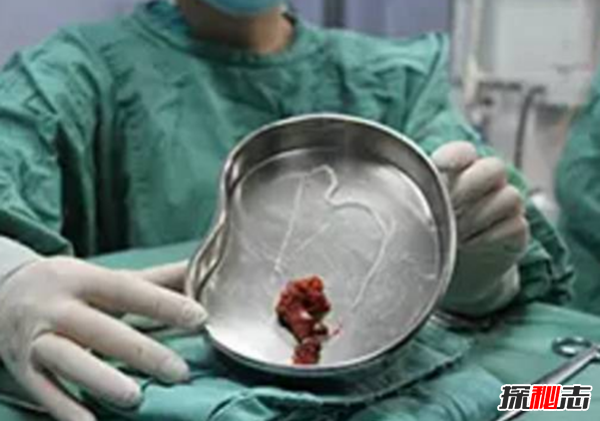 胸部寄生虫是什么?怎么辨别皮肤有寄生虫(严重会危及生命)329 / 作者:UFO爱好者 / 帖子ID:105075