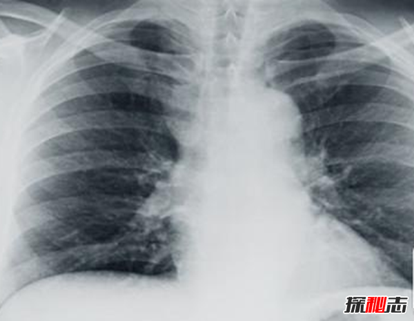 胸部寄生虫是什么?怎么辨别皮肤有寄生虫(严重会危及生命)576 / 作者:UFO爱好者 / 帖子ID:105075