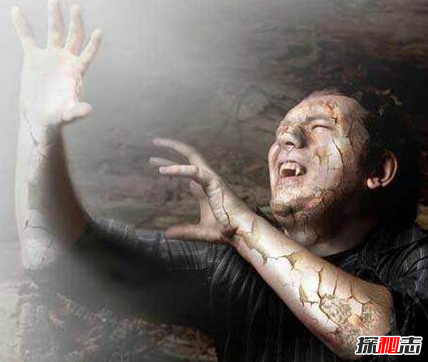 卟啉病为什么要喝血?卟啉病真实患者图片(吸血鬼的原型病)743 / 作者:UFO爱好者 / 帖子ID:105098