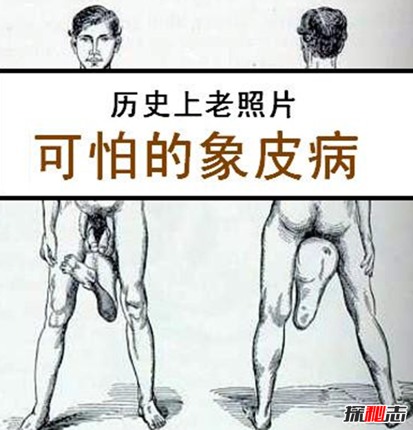 惊人!象皮病是什么病?象皮病可以治愈吗(慢性人体寄生虫病)965 / 作者:UFO爱好者 / 帖子ID:105096