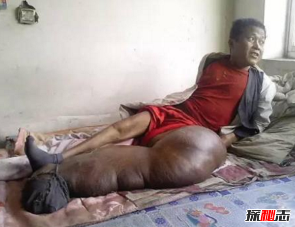 惊人!象皮病是什么病?象皮病可以治愈吗(慢性人体寄生虫病)581 / 作者:UFO爱好者 / 帖子ID:105096