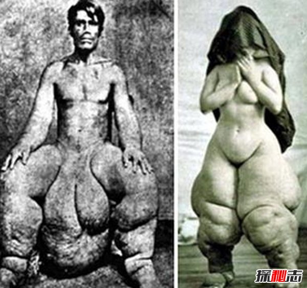 惊人!象皮病是什么病?象皮病可以治愈吗(慢性人体寄生虫病)85 / 作者:UFO爱好者 / 帖子ID:105096