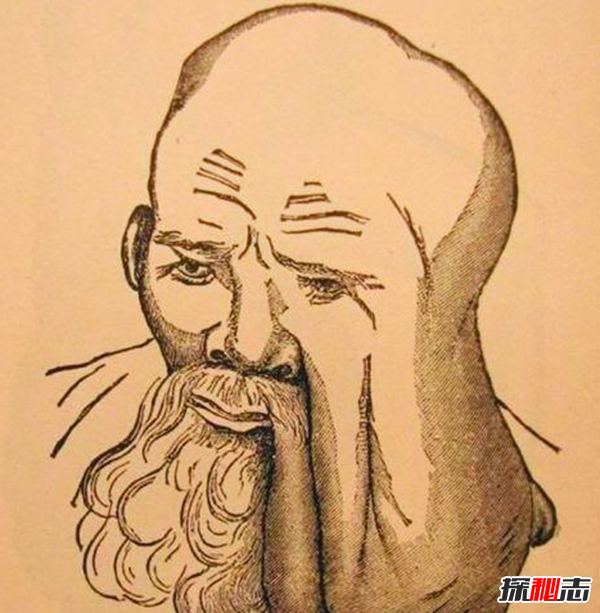 惊人!象皮病是什么病?象皮病可以治愈吗(慢性人体寄生虫病)963 / 作者:UFO爱好者 / 帖子ID:105096