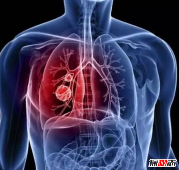 你知道吗?最难治愈的十大癌症,胰腺癌被称为癌中之王(死亡率高)604 / 作者:UFO爱好者 / 帖子ID:104851