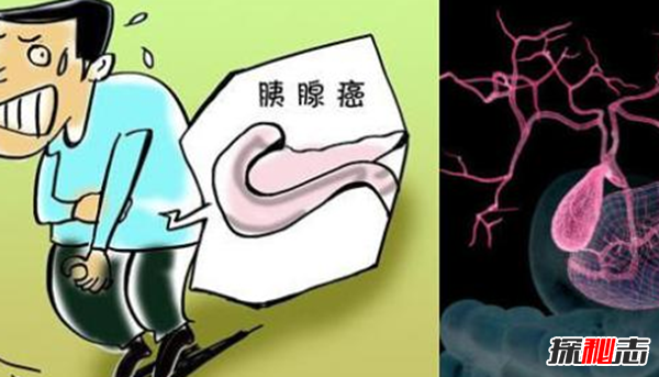 你知道吗?最难治愈的十大癌症,胰腺癌被称为癌中之王(死亡率高)870 / 作者:UFO爱好者 / 帖子ID:104851