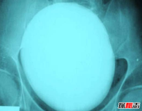 x光片发现十大最恐怖的东西,你绝对想不到居然有它986 / 作者:UFO爱好者 / 帖子ID:104595