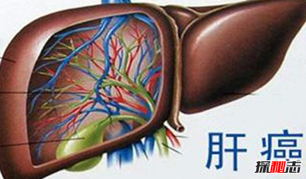 肝癌发病率最高的国家排名 埃及榜上第四,第一酒精过度依赖79 / 作者:UFO爱好者 / 帖子ID:97700