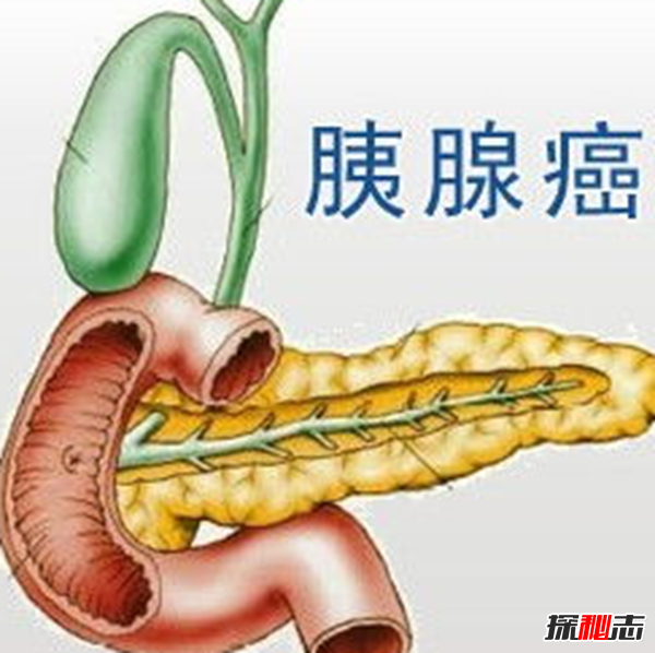胰腺癌发病率最高的十大国家 无中国,日本榜上第七147 / 作者:UFO爱好者 / 帖子ID:97701