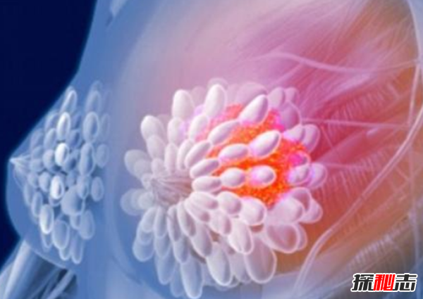 乳腺癌发病率前十国家排名 法国第三,基因突变好可怕785 / 作者:UFO爱好者 / 帖子ID:97679