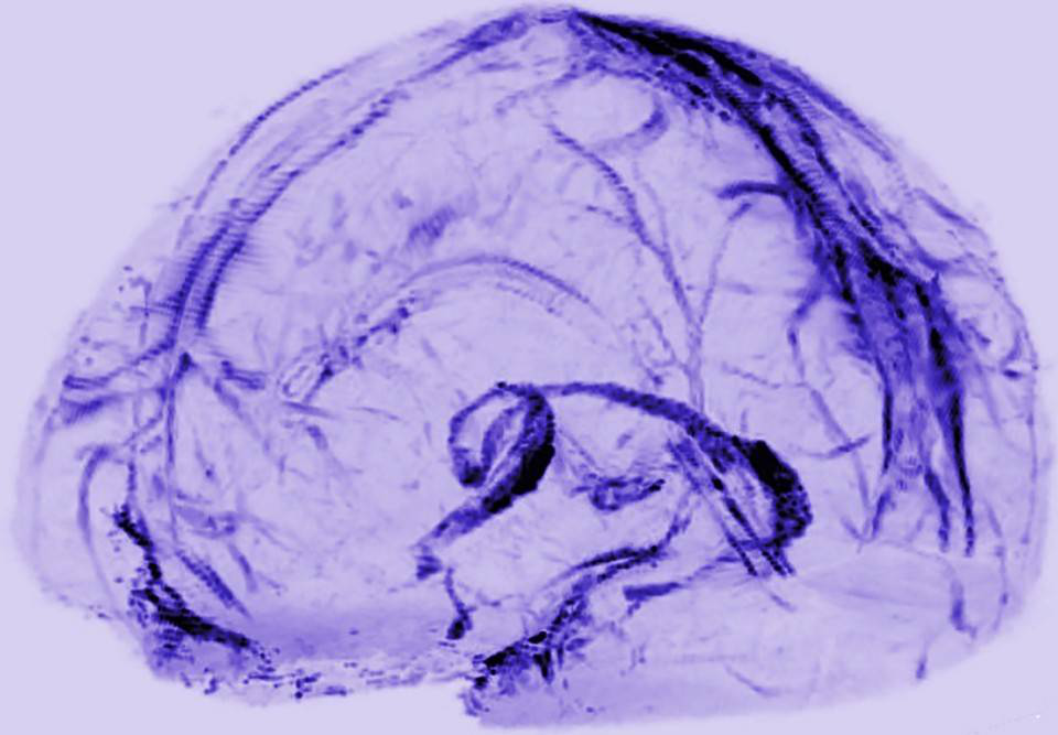 大脑“排毒系统”揭晓:科学家首次在人脑发现淋巴系统178 / 作者:UFO爱好者 / 帖子ID:85906 大脑“排毒系统”揭晓:科学家首次在人脑发现淋巴系统178 / 作者:UFO爱好者 / 帖子ID:85906