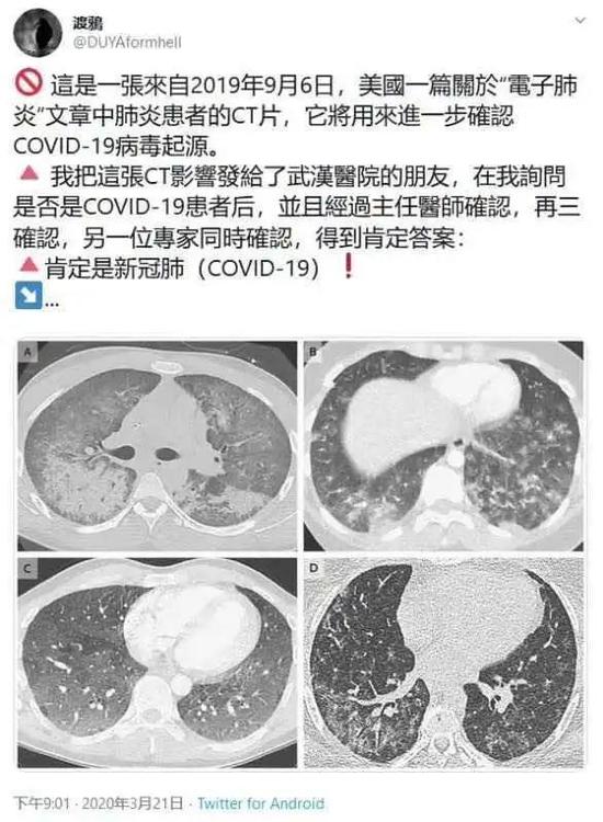 电子烟肺炎和新冠肺炎，到底有没有关联？655 / 作者:UFO爱好者 / 帖子ID:81593
