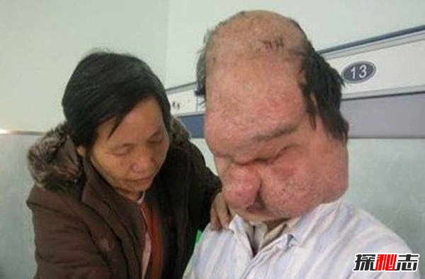 盘点世界上十大恐怖怪病,蓝肤症挑战人种认知133 / 作者:UFO爱好者 / 帖子ID:105391