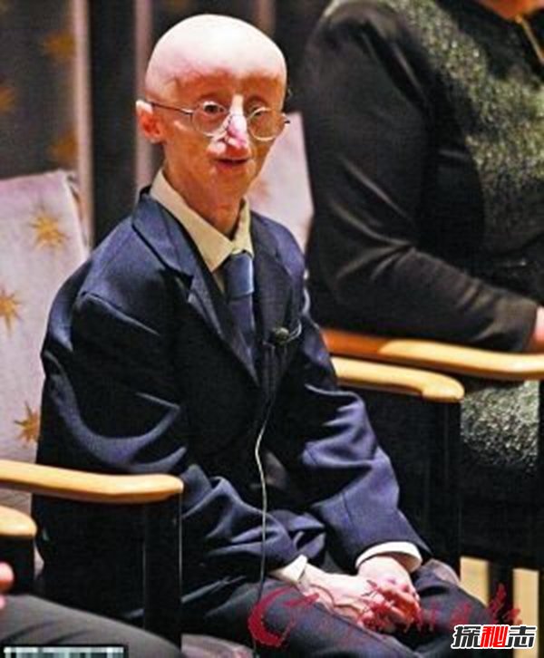19岁少女身体似150岁真相吓人(早衰症的恐怖)618 / 作者:UFO爱好者 / 帖子ID:105322