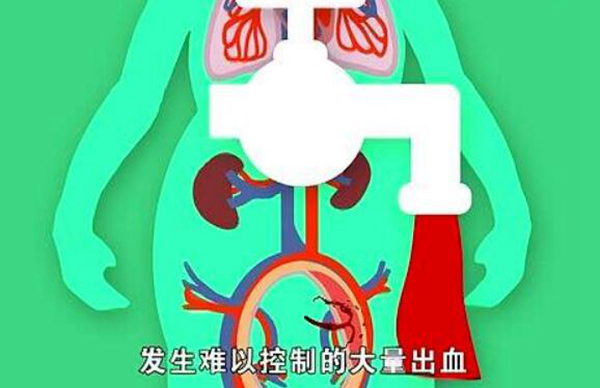 羊水栓塞是什么?羊水栓塞主要原因是什么(80%死亡率)880 / 作者:UFO爱好者 / 帖子ID:84403