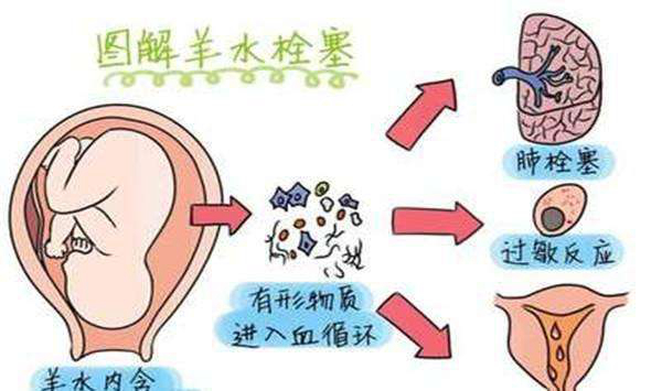 什么人易得羊水栓塞?这六种孕妇一定要注意(极度凶险)97 / 作者:UFO爱好者 / 帖子ID:83745