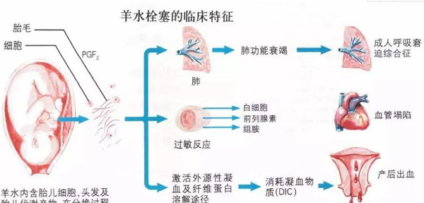 什么人易得羊水栓塞?这六种孕妇一定要注意(极度凶险)420 / 作者:UFO爱好者 / 帖子ID:83745