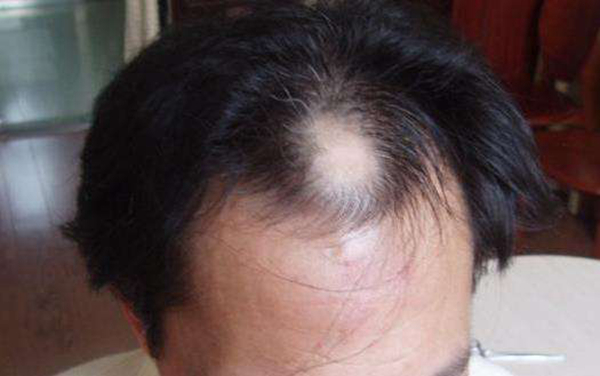 年轻人脱发怎么办?脱发应该如何治疗(食疗、药物治疗)776 / 作者:UFO爱好者 / 帖子ID:83671
