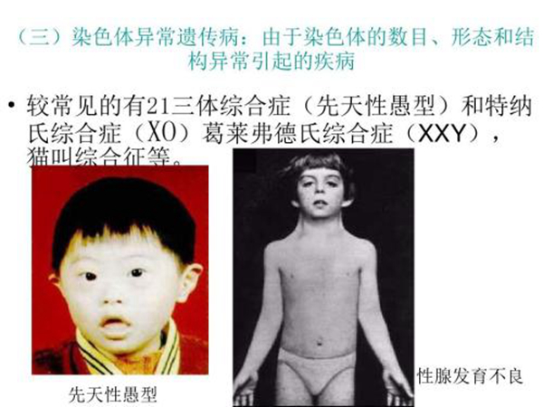 威廉斯氏综合症：基因缺失造成的先天疾病（无法治愈）282 / 作者:UFO爱好者 / 帖子ID:80936