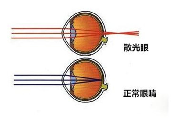 散光是怎么造成的 人为什么会发生散光764 / 作者:UFO爱好者 / 帖子ID:88981