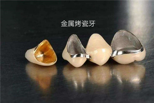 烤瓷牙可以使用电动牙刷吗 使用烤瓷牙时应该如何护理997 / 作者:UFO爱好者 / 帖子ID:88398
