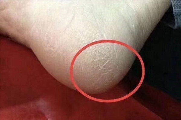 脚皮破了怎么处理 脚皮破了可以用双氧水消毒吗193 / 作者:UFO爱好者 / 帖子ID:88172