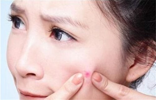 熬夜长痘怎么办 熬夜长痘应该如何处理呢949 / 作者:UFO爱好者 / 帖子ID:87565