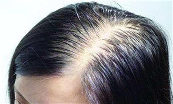 掉头发是因为什么 多种因素可能导致掉头发893 / 作者:UFO爱好者 / 帖子ID:87433