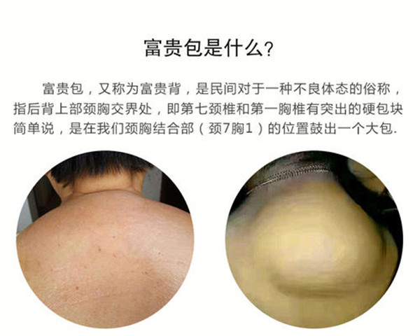 富贵包长什么位置 富贵包对人体危害有哪些249 / 作者:UFO爱好者 / 帖子ID:87323