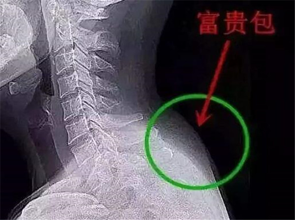 富贵包长什么位置 富贵包对人体危害有哪些908 / 作者:UFO爱好者 / 帖子ID:87323