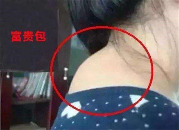 富贵包长什么位置 富贵包对人体危害有哪些350 / 作者:UFO爱好者 / 帖子ID:87323