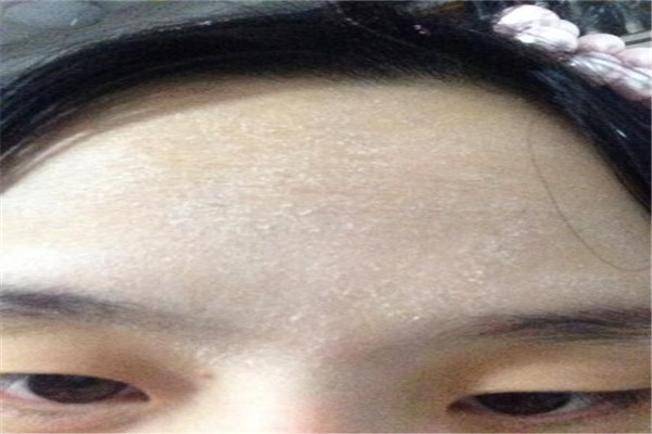 秋季皮肤起皮怎么办 治疗皮肤起皮方法有哪些887 / 作者:UFO爱好者 / 帖子ID:84332