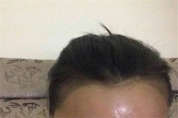 纹发际线的危害有哪些 纹发际线会留下隐性的疤痕104 / 作者:UFO爱好者 / 帖子ID:83788