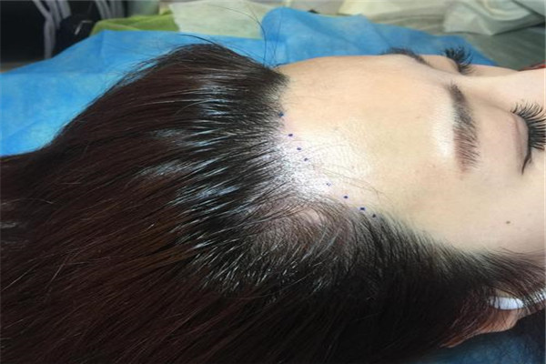 纹发际线的危害有哪些 纹发际线会留下隐性的疤痕908 / 作者:UFO爱好者 / 帖子ID:83788